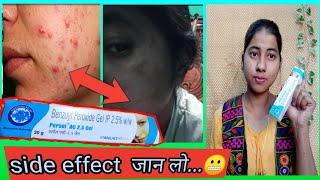 Benzoyl Peroxide Gel 2.5%  Review In Hindi || Uses And Side Effect || miss glossy girl ||