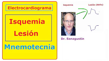 ¿Cuáles son los signos de isquemia en el ECG?