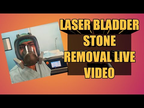 Video: Removal Of Stones From The Gallbladder (crushing Stones With Laser And Ultrasound)