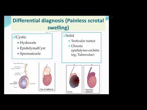 Testicular tumor —part 2 (diagnosis & management)