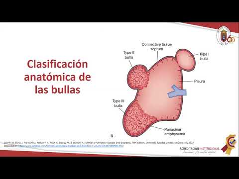 SEMINARIO: “ENFERMEDAD BULOSA PULMONAR, ENFOQUE QUIRÚRGICO” Estudiantes VIII semestre UPA 22/09/2020