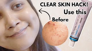 How to  Use Tretinoin *Correctly! Before & After Results!