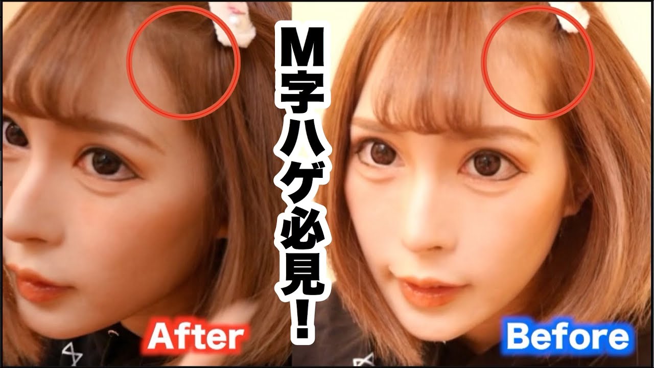 M字ハゲの人は参考にしてほしい コスパ良し Youtube