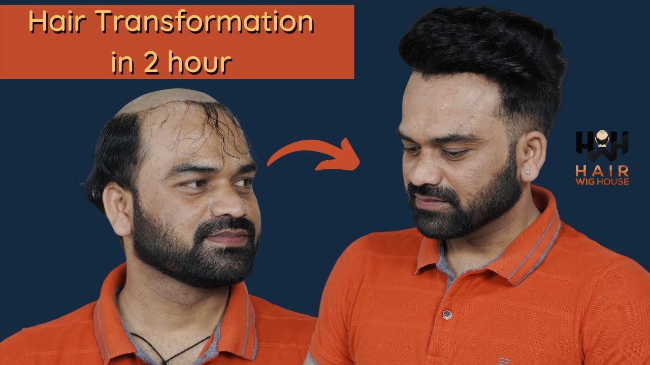 Non Surgical Hair Replacement | Hair Patch for Men in Delhi | 9953384242  @Hairwighouse - YouTube