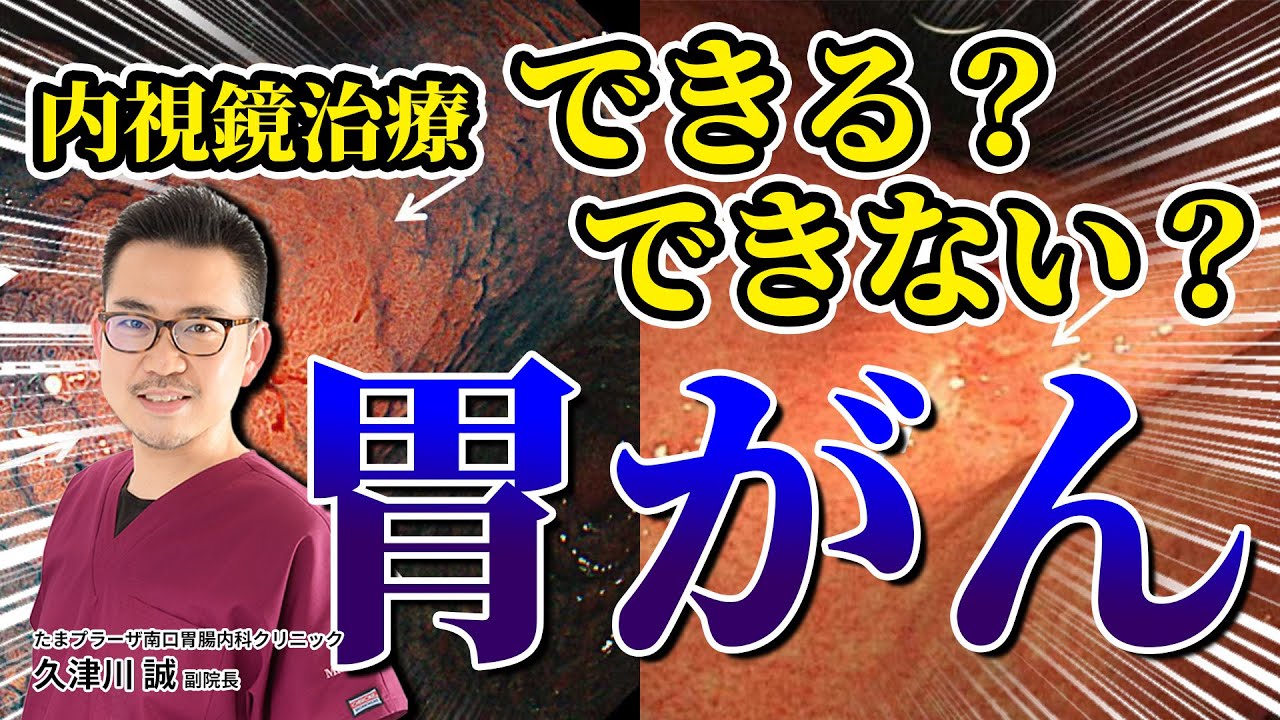 この胃がん　内視鏡治療できる？　外科的手術が必要？  教えて久津川先生 No193