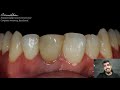 How to fix a discolored tooth