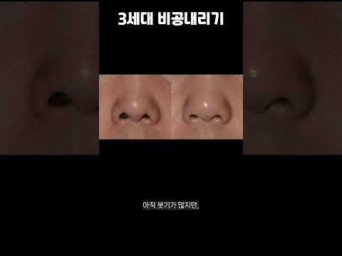 심한 짝짝이 콧구멍 교정사례 Ft 전후사진