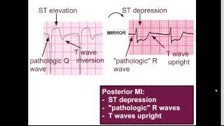 Posterior MI:  