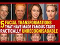 25 Facial Transformations That Have Made Famous Stars Practically Unrecognisable  #plasticsurgeon