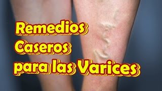 Remedios Caseros para las Varices en las Piernas, Como Eliminar Venas Varicosas(Remedios Caseros para las Varices en las Piernas, Como Eliminar Venas Varicosas. Para evitar su aparición o que empeore la condición de las varices ..., 2016-11-07T21:46:27.000Z)