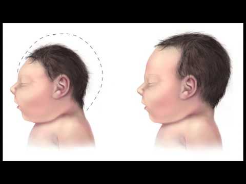 Zika Virus and Birth Defects
