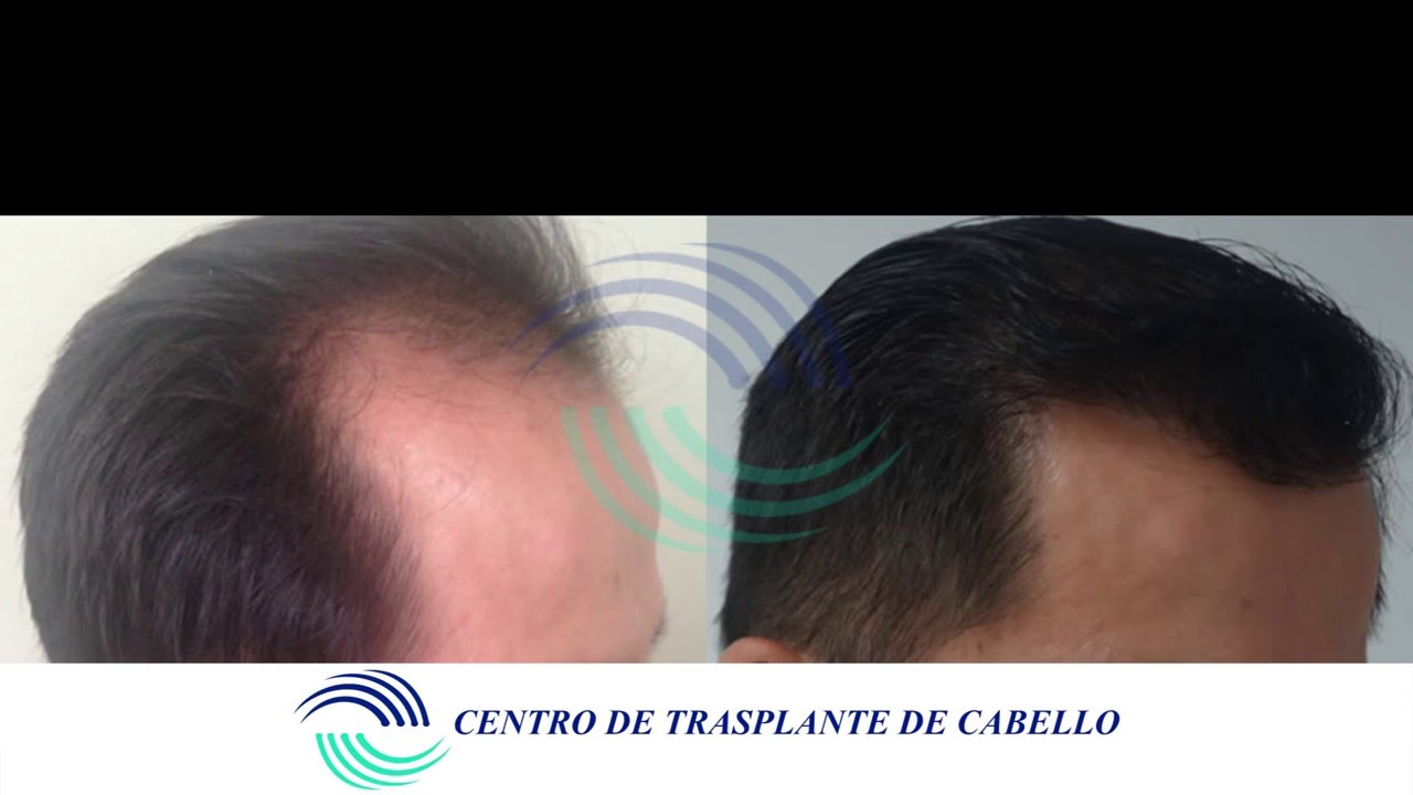 Trasplante de Cabello FUE Un año Antes y Después YouTube