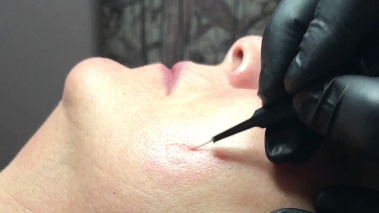 skin sheek treatment near me
