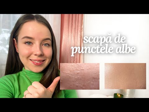 CUM SCAPI DE PUNCTELE ALBE? | Chiar funcționează!!👍