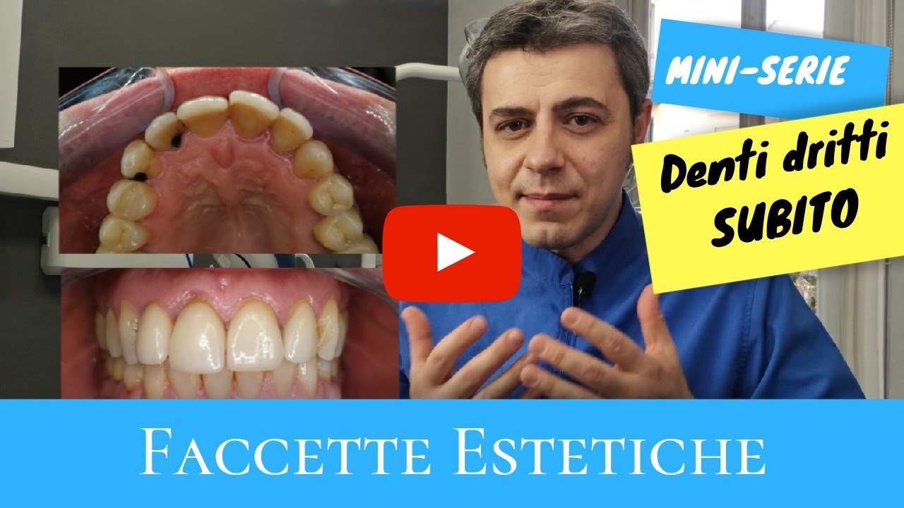 Denti dritti subito: faccette estetiche