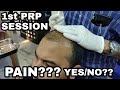 My 1st PRP SESSION || HAIR TRANSPLANT IN INDIA 2018 || NO PAIN NO GAIN