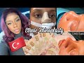 5 months Post Ethnic Rhinoplasty w/ Dr. Umit Taskin - Update, My experience in Turkey, and Cast Off