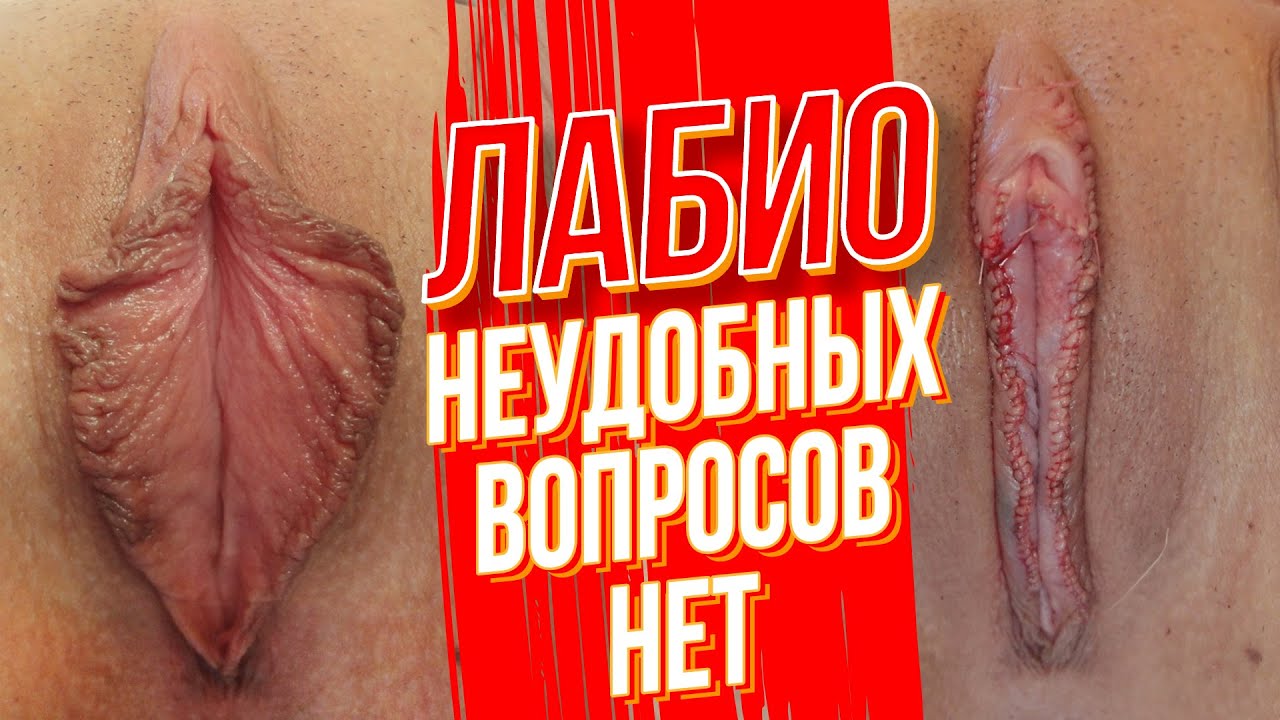 Пластика малых и больших половых губ (лабиопластика)