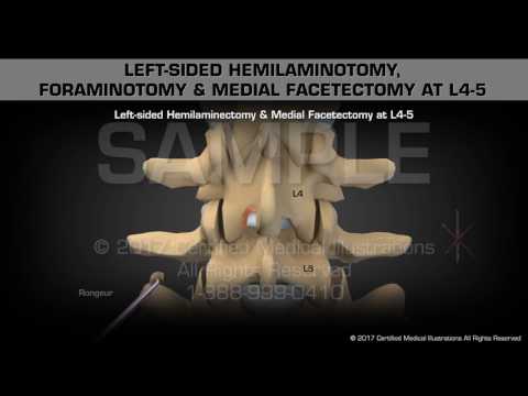 Left-sided Hemilaminotomy, Foraminotomy & Medial Facetectomy at L4-5