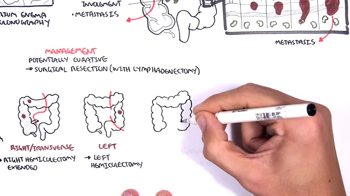 Colorectal Cancer - Overview - DayDayNews