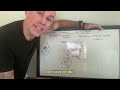 White Board Series: Hypothyroidism, Serotonin &amp; T3: Hidden Biomarkers in Autism &amp; Parkinson’s