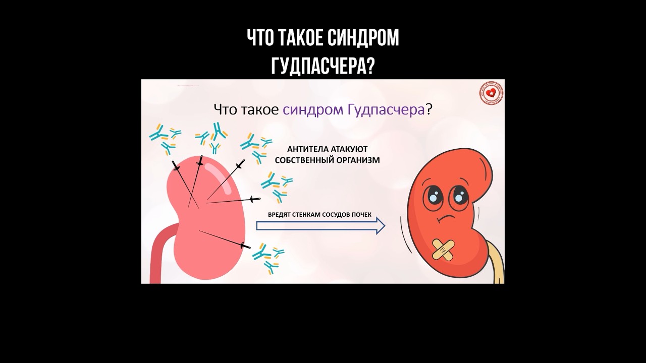 Что такое синдром Гудпасчера? #почки #нефрология #больныепочки #синдромгудпасчера