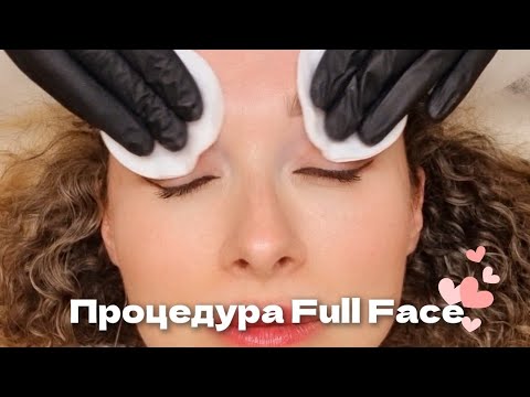 Процедура Full Face («Фулфейс») , препарат КСЕОМИН #фулфейс #fullface #ботокс #омоложение