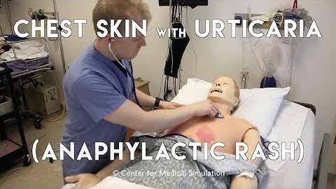 Moulage 101: Chest Skin with Urticaria (Anaphylactic Rash) | Mad Simulationist