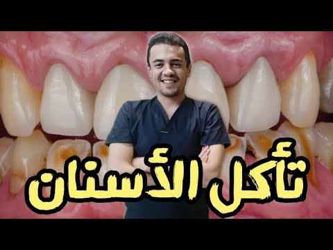 علاج تآكل الاسنان (كيفية تقوية الأسنان 🦷)