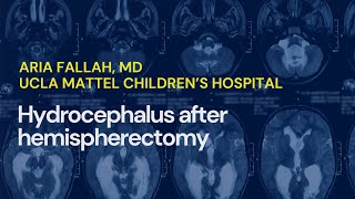 Hydrocephalus • Aria Fallah, MD, MSc, FRCSC