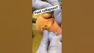 Look what we found under this callus!🤯😳 #shorts #callus