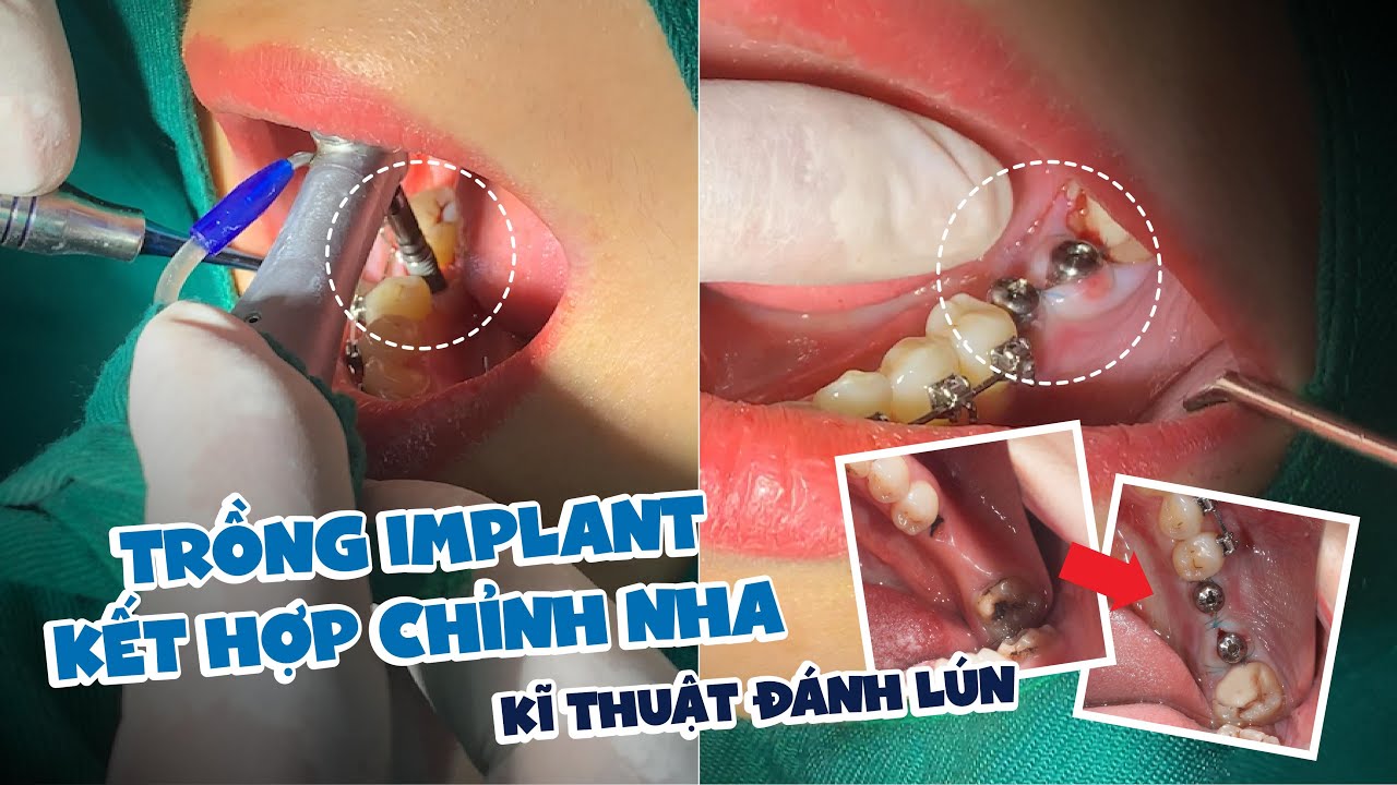Để Mất Răng Lâu Ngày, Phải Đánh Lún Răng Đối Diện... - youtube