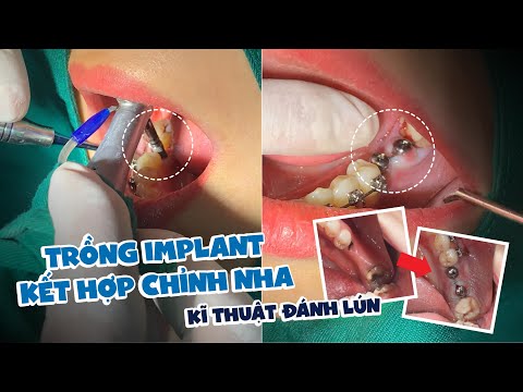 Video Để Mất Răng Lâu Ngày, Phải Đánh Lún Răng Đối Diện... - youtube