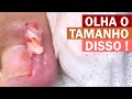 Olha o tamanho dessa espícula!  [Renata Werneck Podóloga Unha Encravada REMOVE INGROWN NAIL]