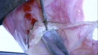 îndepartare video chirurgicala varicoza