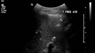 free air in the abdomen.avi