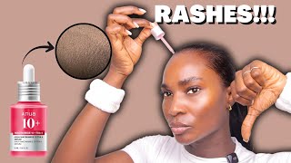 This Viral Serum Gave Me Rashes: My Anua Niacinamide Warning