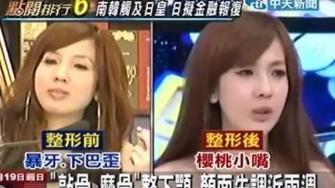 大学生小白张艾亚削骨正颚整形手术只为变美 - 天天要闻
