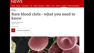 Signs of Blood Clots after AstraZeneca Vaccine - What to watch out for.