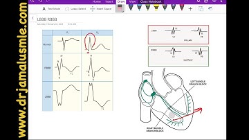 LBBB and RBBB (left VS right bundle branch block)-  Dr Jamal USMLE -  Cardiology ECG lecture
