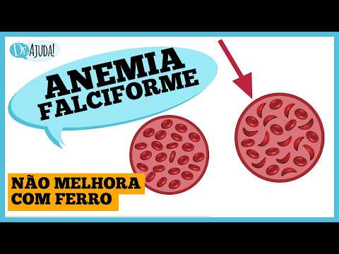 Anemia that doesn't improve with iron? Everything about Sickle Cell Disease with a hematologist
