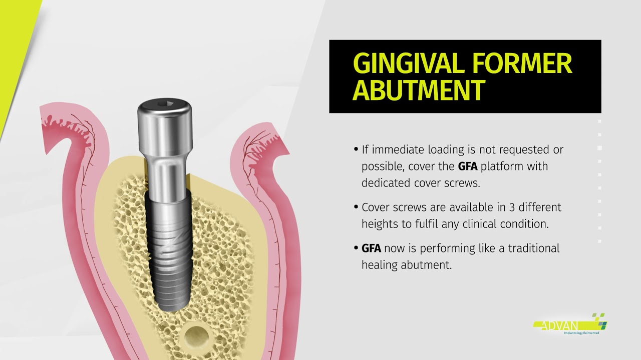 Chapter 03 The Gingival Former Abutment YouTube
