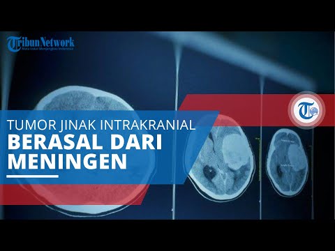 Meningioma, Tumor Jinak Intrakranial Berasal dari Meningen dan Tumbuh di Luar Jaringan Parenkim Otak