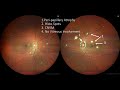 Not on the Map, But in the Eye: A POHS Mystery from India