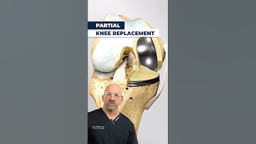 How Partial Knee Replacement Is REALLY Done⁉️