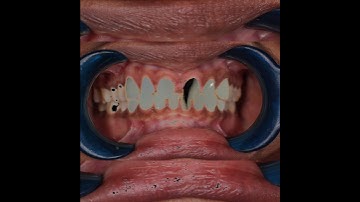 Diastema  closure in one day with digital smile designing.# single sitting gap closures# cad/cam