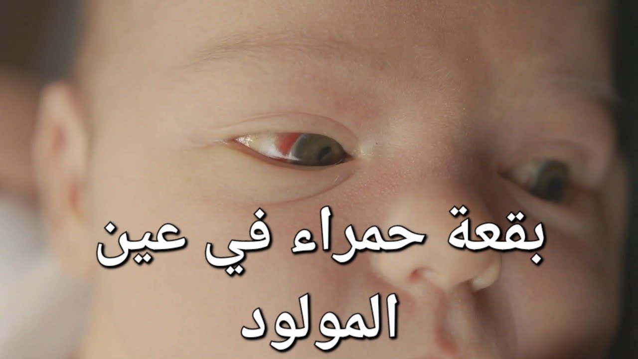 بقعة حمراء في عين المولود