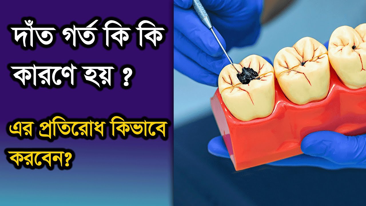 দাঁত গর্তের কারণ কি কি ? প্রতিরোধ কিভাবে করবেন ? Tooth Cavity Home Remedy In Bangla Dental