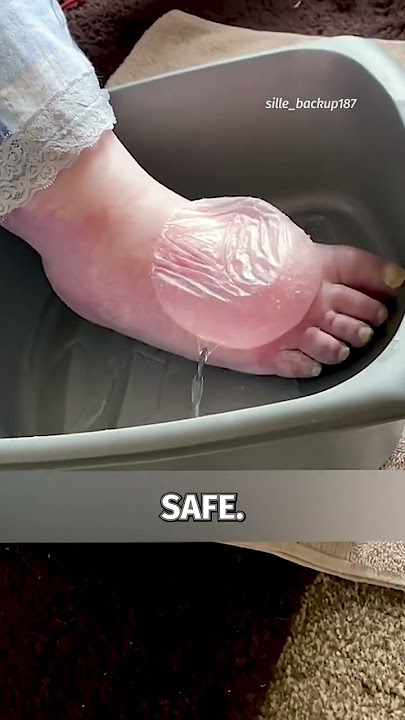 Largest Blister You Have Had or Seen? 🎈How did you treat it?? #shorts