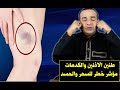 طنين الأذنين والكدمات الحمراء وعلاقة ذلك بالسحر والحسد